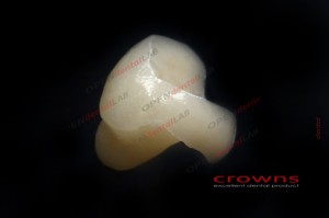 Crowns - in onley pełnoceramiczny - ZESTAW zdjęć Internet