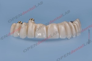 Punkt w moście przykręcany na implantach All in One porcelanowy na metalu Crowns cad/cam 09pkt
