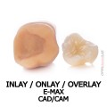 inlay onlay overlay e-max cad cam.jpg