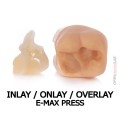 inlay onlay overlay e-max press.jpg