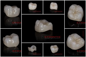 Crowns - korona pełnokonturowa - ZESTAW zdjęć Internet